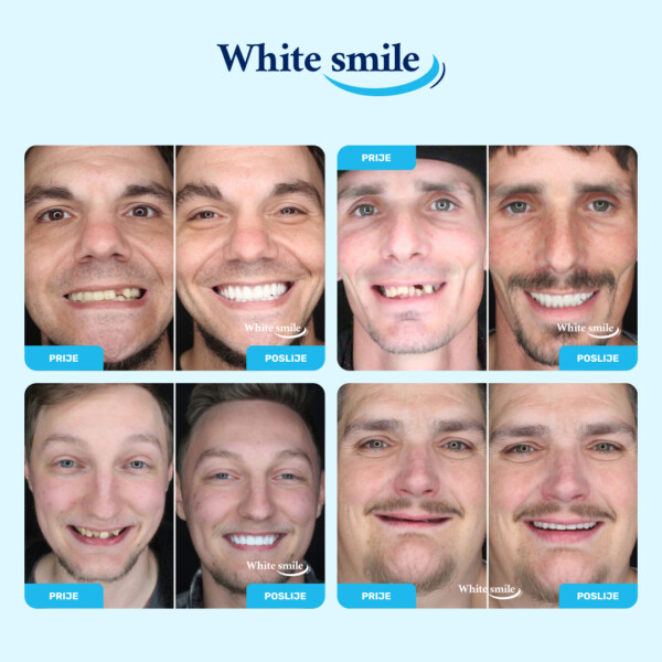 Umjetni zubi realističnog izgleda: WhiteSmile - Slika 3